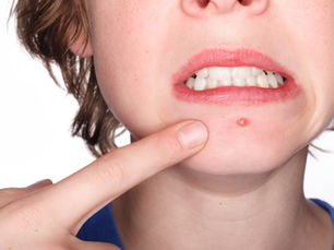 Tratamento da Acne