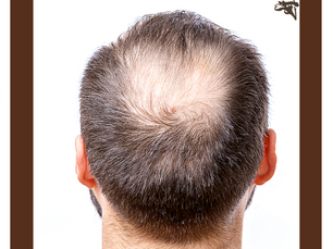 Alopecia Androgenética | Conheça Androtase™