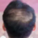 脫髮問題