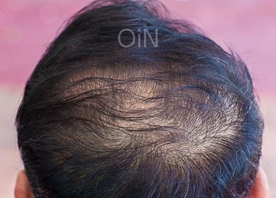 ANDROGENETIC ALOPECIA_edited.jpg