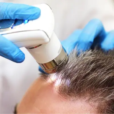 Close-up of a professional scalp analysis using a microscopic camera to examine hair follicles at OiN Hair.