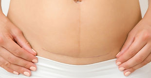 Khuyết Sẹo Mổ Lấy Thai Và Vô Sinh