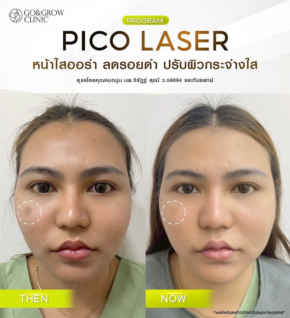 Before-and-after clinic ad for PICO LASER showing a woman's face with reduced cheek spots; Thai text and THEN/NOW labels.