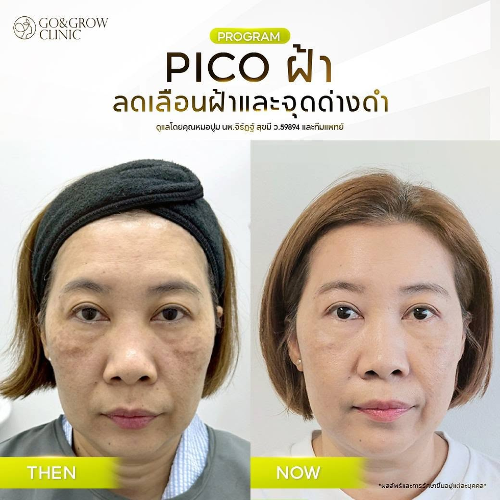 ภาพก่อน-หลังหญิงทำโปรแกรม PICO ฝ้า ลดเลือนจุดด่างดำที่ GO&GROW CLINIC มีป้าย THEN/NOW