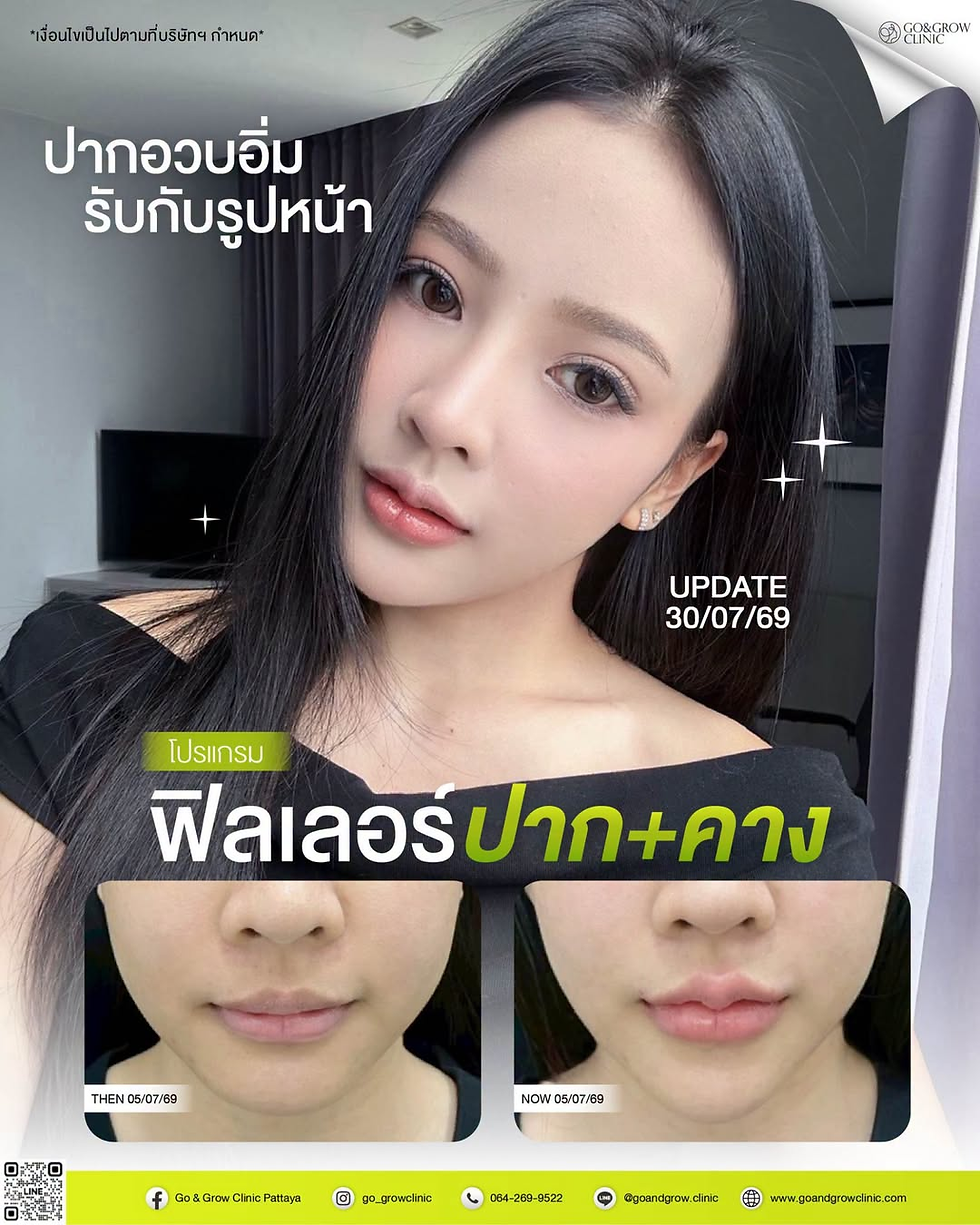 โปสเตอร์คลินิกโชว์หญิงผมยาวหลังฟิลเลอร์ปาก+คาง มีภาพก่อน-หลัง ข้อความอัปเดต 30/07/69 บรรยากาศสวยมั่นใจ