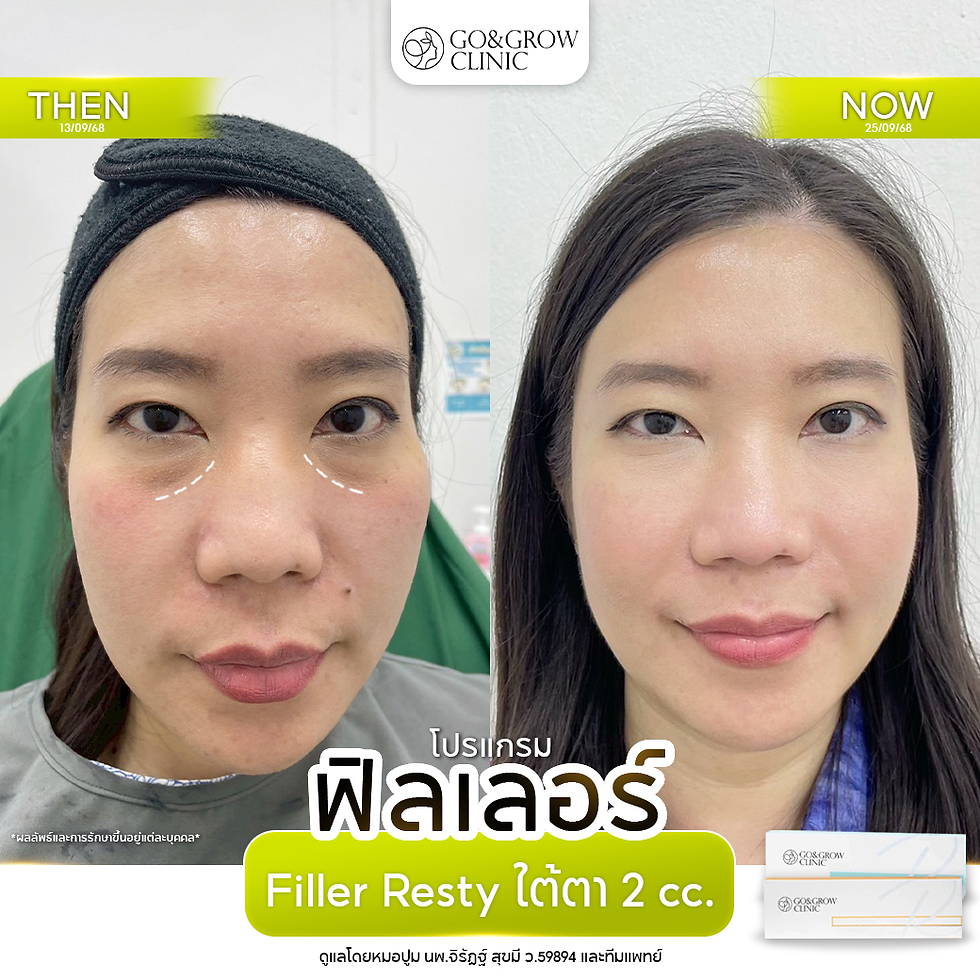 Before-and-after woman portrait at Go&Grow Clinic, showing under-eye filler results and Thai text about Filler Resty 2 cc.