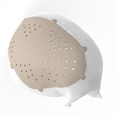 رأب القحف 2.1.JPG