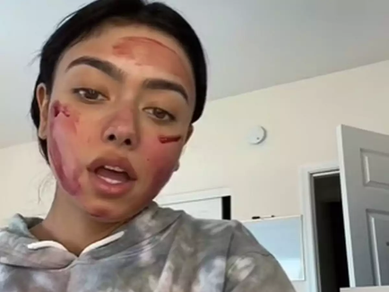 Η νέα τάση στο TikTok που ανησυχεί τους γιατρούς!