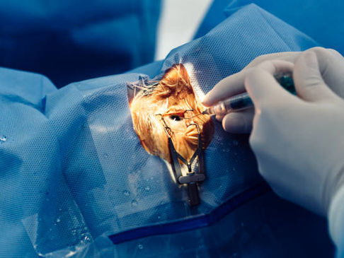 Lens replacement surgery for High Myopia