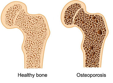 osteoporosis