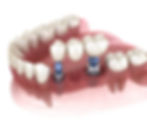 Implant and Prosthetic Dentist in Arlington, Texas - Arlington Dental Lounge