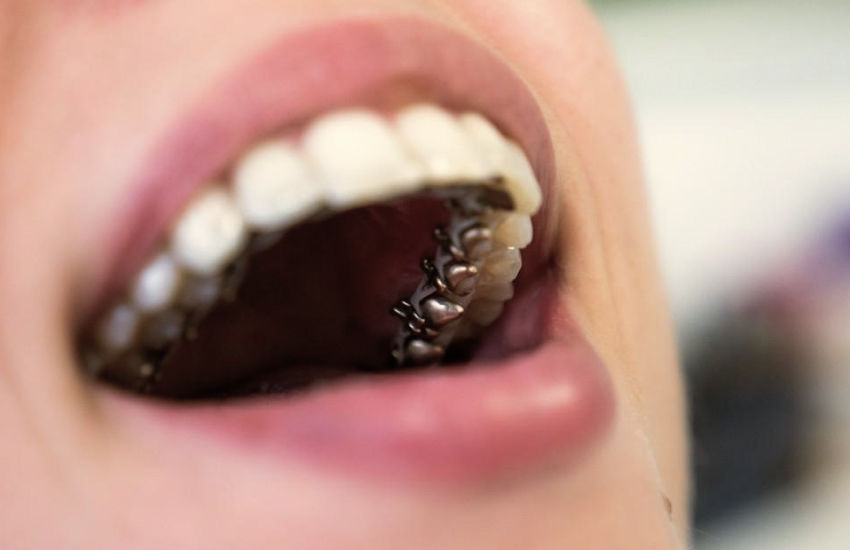 Lingual Braces in Cypress, Texas - Marigold Family Dentistry