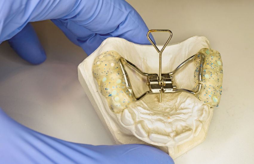 Palatal Expanders in Cypress, Texas - Marigold Family Dentistry