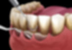 Periodontal Therapy in Spokane, Washington - Dentures & Dentistry Spokane
