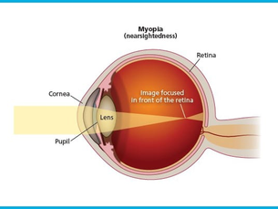 'Myopia Progression: Addressing Vision Health in the Modern World'