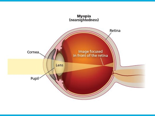 'Myopia Progression: Addressing Vision Health in the Modern World'