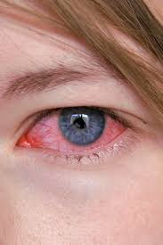 Close-up of a blue eye with red, irritated skin around it. The eye appears slightly bloodshot. Light skin tone, focused, neutral mood.