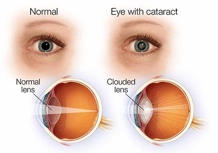 EYES WITH CATARACT