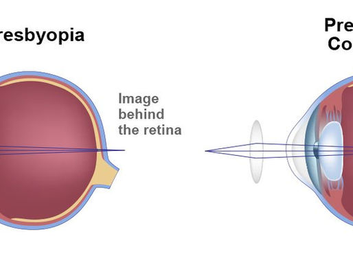 Presbyopia