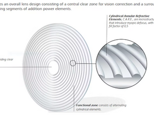 ZEISS C.A.R.E. TECHNOLOGY FOR MYOPIA PROGRESSION CONTROL