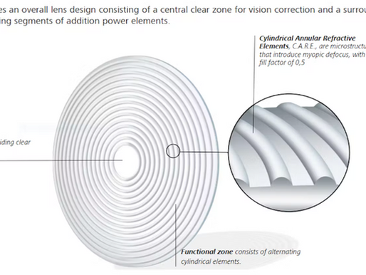 ZEISS C.A.R.E. TECHNOLOGY FOR MYOPIA PROGRESSION CONTROL