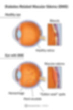 Diagram comparing a healthy eye and one with macular edema. Labels highlight healthy retina, edema, hemorrhage, and exudate.