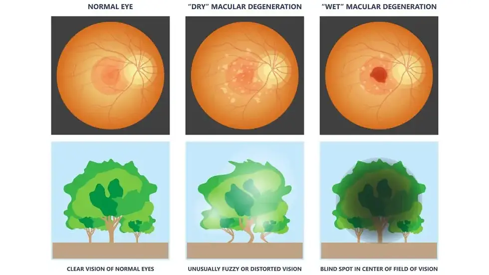 Comparison of normal eye, dry, and wet macular degeneration; shows clear, fuzzy, and blind spot vision using tree illustrations.