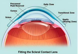 The Science behind Scleral Lenses