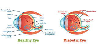 DIABETIC EYE
