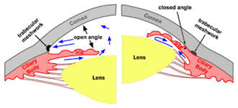Understanding Open-Angle Glaucoma: The Silent Thief of Sight
