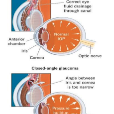 CLINICAL APPEARANCE OF ANGLE CLOSURE GLAUCOMA