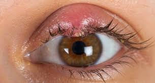 Close-up of a brown eye with red, swollen eyelid, indicating an infection or irritation. Background is skin-toned, with visible eyelashes.