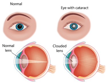 CATARACT AWARENESS TODAY