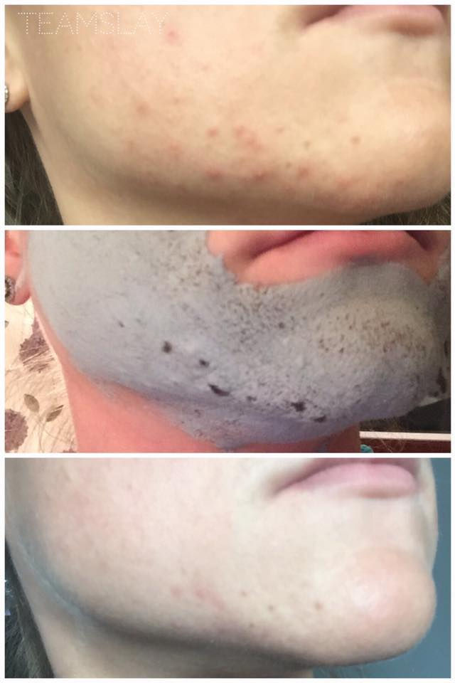 Thumbnail: EPOCH® GLACIAL MARINE MUD®