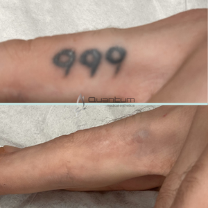Very heavily inked tattoo 99% cleared after 6 treatments