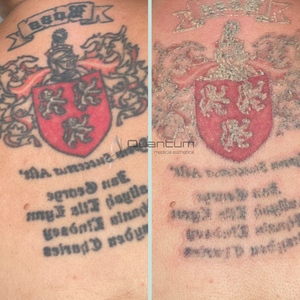 Temporary frosting effect immediately post treatment