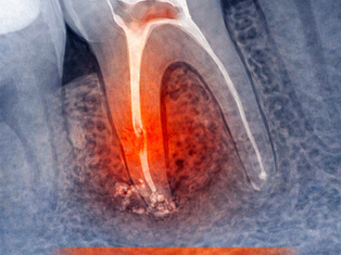 Failed Root Canal: Why Pain Persists — and What You Can Do Next