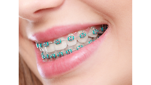 Braces.png