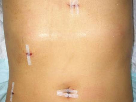 手術して感じたこと