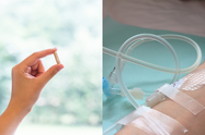 Iron Infusion vs. Oral Supplements: Which is Right for You?
