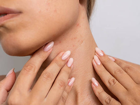 How Acne Treatment Combines with Skincare Routines