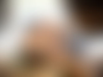 What Hair Transplant Offers Over PRP Alone