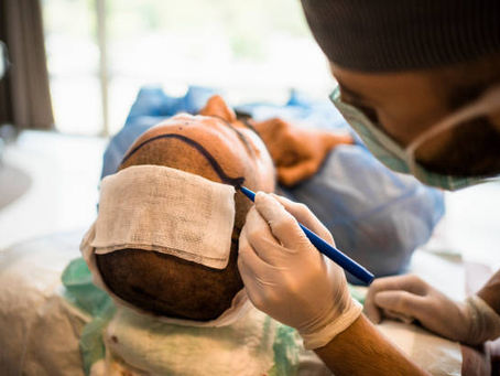 What Hair Transplant Offers Over PRP Alone