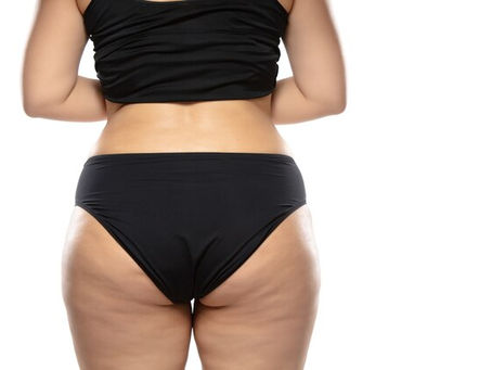 Your Ideal Silhouette Starts with Brazilian Butt Lift