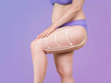 Is a Thigh Lift Right for Post-Pregnancy Moms?