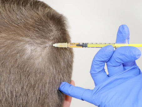 What Makes PRP Hair Treatment a Top Choice?