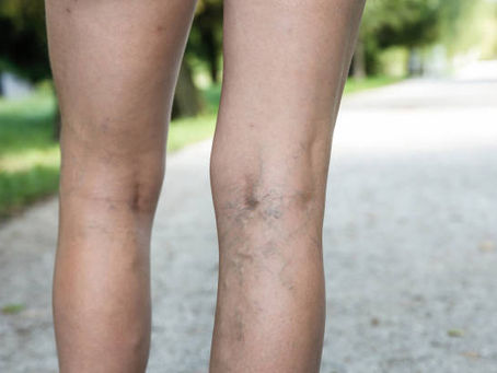 Is Sclerotherapy Recommended by Vein Experts?