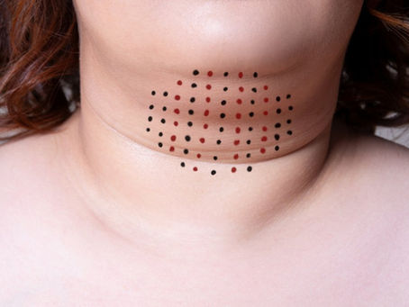 What Changes After Double Chin Liposuction?