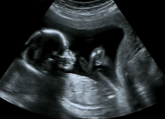Ultrasonido 3D - Ultrasound 3D
