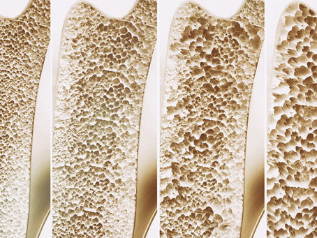 Osteoporoz Nedir?
